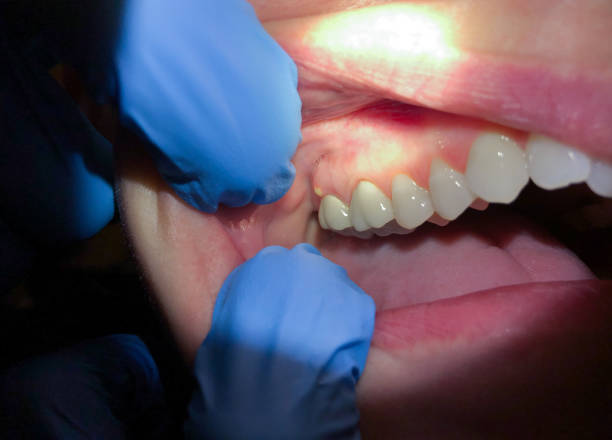 Best Emergency Treatment for Dental Infections or Abscesses in Glasgow, KY